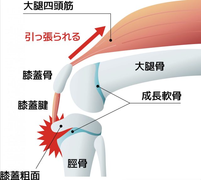 オスグッド　重症　膝蓋腱