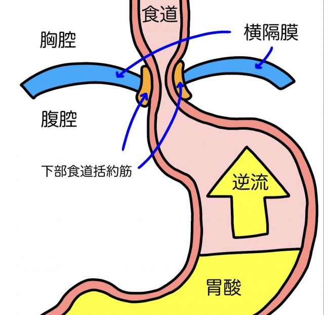 逆流性食道炎