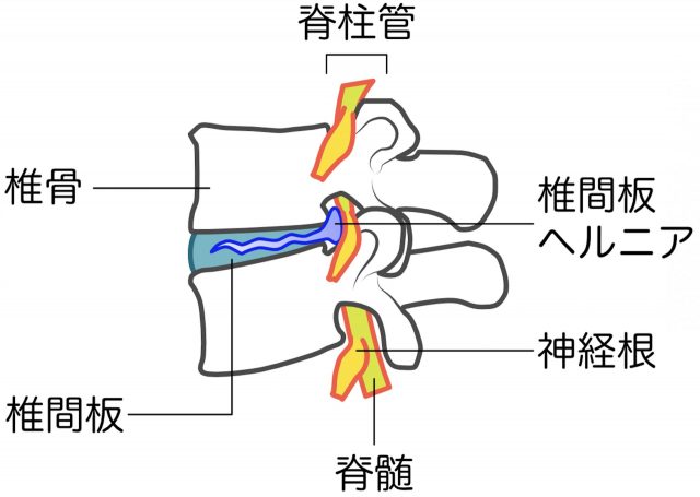 椎間板ヘルニア