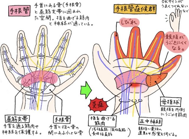 手根管症候群