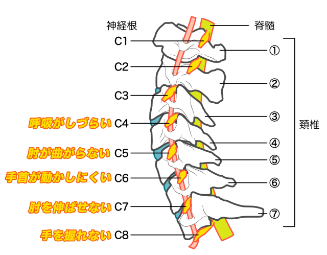 頚椎症性神経根症