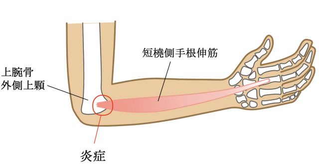 上腕骨外側上顆炎　テニス肘