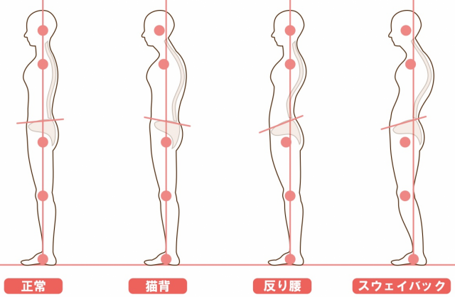 姿勢　正常　猫背　反り腰　スウェイバック