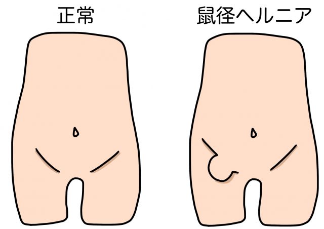 鼠径ヘルニア