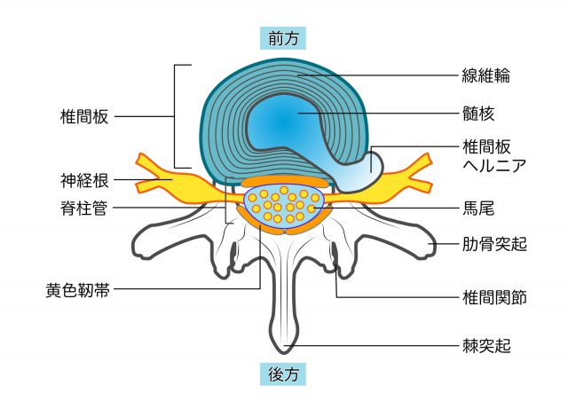 椎間板ヘルニア