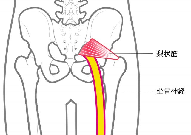 梨状筋　坐骨神経痛