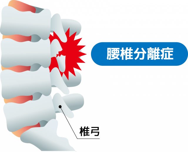 腰椎分離症