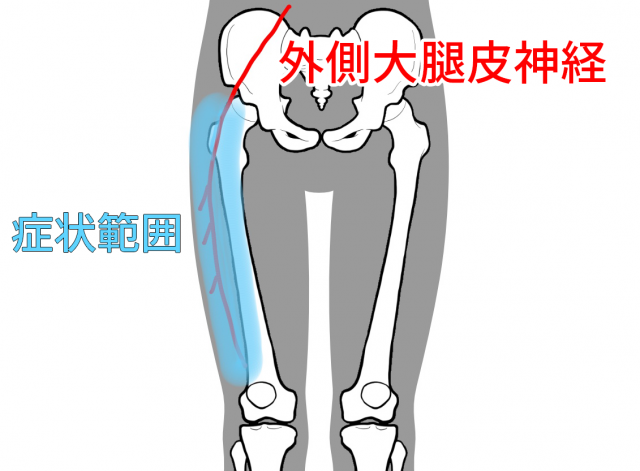 外側大腿皮神経