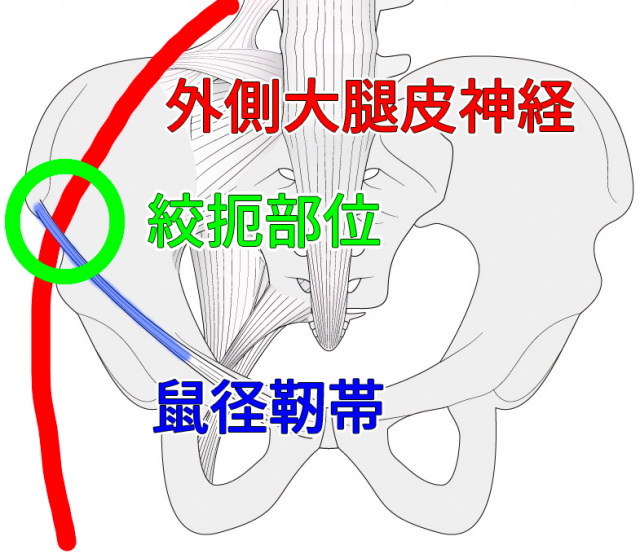 外側大腿皮神経痛