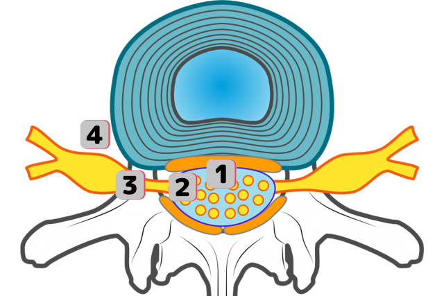 椎間板ヘルニアの種類　場所