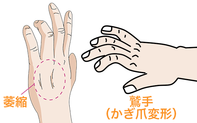 ギヨン管症候群　鷲手　かぎ爪変形