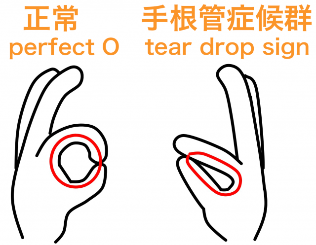 手根管症候群 tear drop sign perfectO