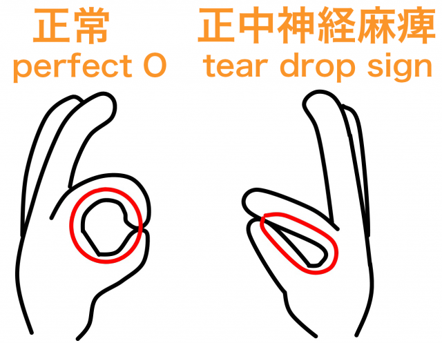 正中神経麻痺 tear drop sign perfectO